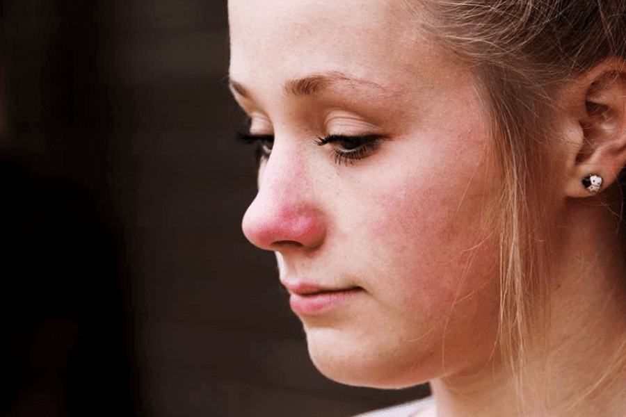 A young woman with a red nose staring down